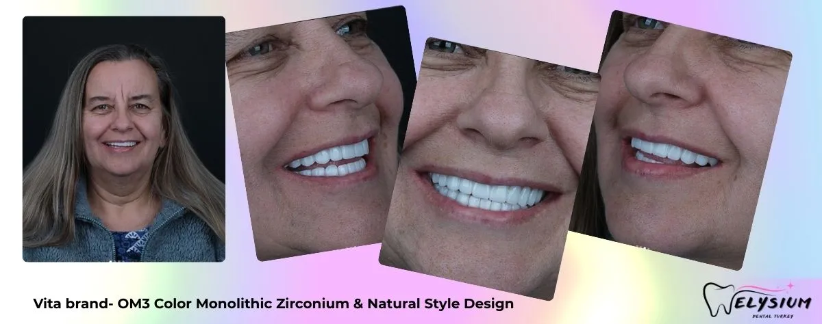 All on 4 dental implants before after Antalya Turkey All on 4 dental implants before after Antalya Turkey